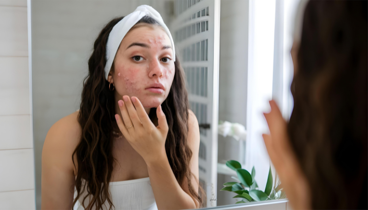 Clearer Skin Starts Today: Simple Tips for Beating Acne!